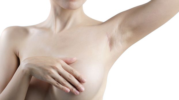 Woman showing keloids or scar on the armpit after breast surgery
