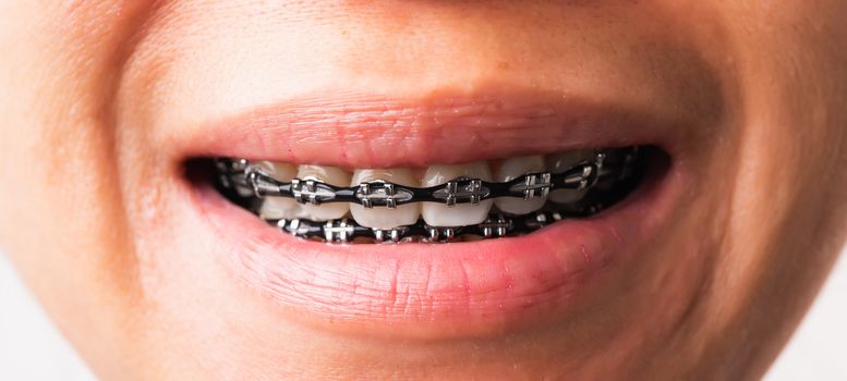 Woman smile show mouth with white teeth with black brackets brac