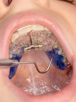 Dentist checking bracket at the braces of kid