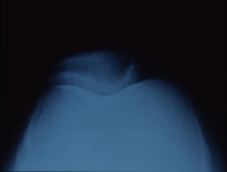 X-ray image of the kneecap with joint