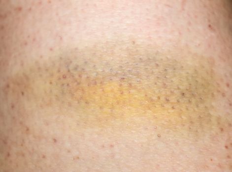 Large bruise hematoma on the humans leg on the skin in different