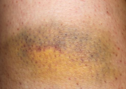 Large bruise hematoma on the humans leg on the skin in different