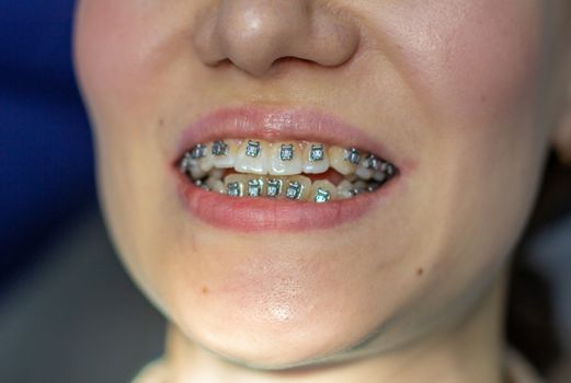 A woman with braces on her teeth visits an orthodontist, in a dental chair. during the procedure of installing the arch of braces on the upper and lower teeth. The girl smiles.The concept of dentistry