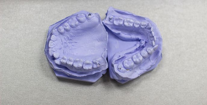 Plaster cast of teeth from plaster at the orthodontist. 