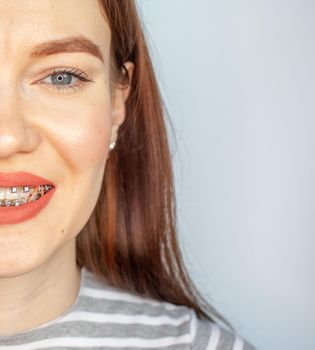 Braces in the smiling mouth of a girl. Close-up photos of teeth and lips. Smooth teeth from braces. Photo on a light solid background.