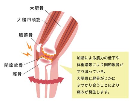 Knee joint pain (gonarthrosis / osteoarthritis / arthrosis of knee ) . flat illustration