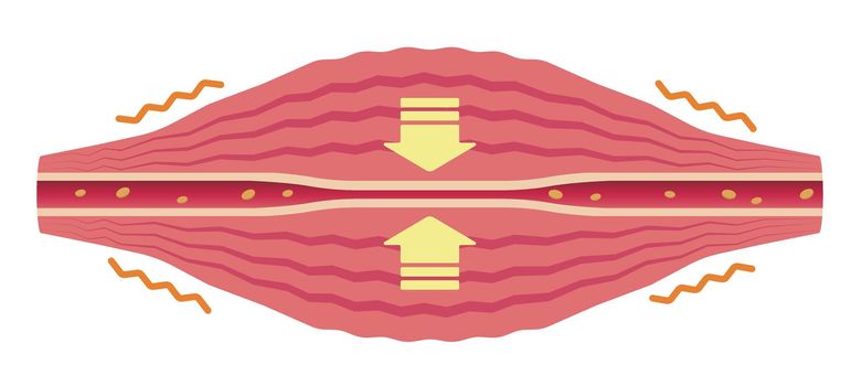 Fatigue factors accumulate . Flat illustration of muscle and vessel.