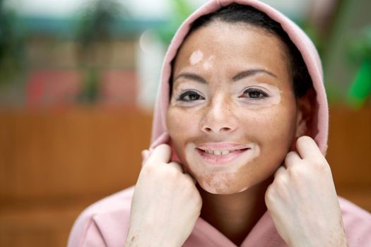 Black african american woman with vitiligo pigmentation skin problem indoor dressed pink hoodie