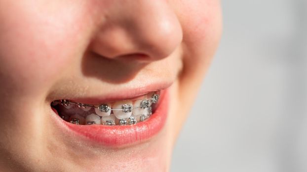 Close up of a teenage girl smiling in orthodontic brackets. Girl with braces on teeth.