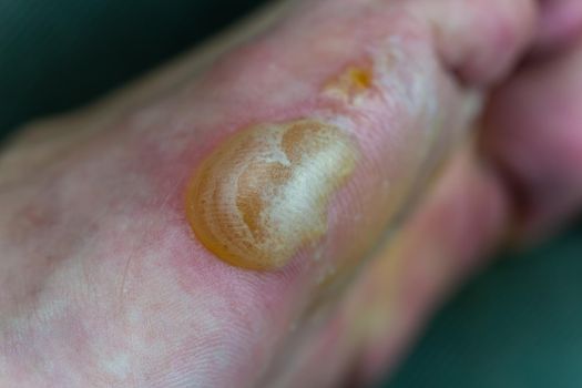 Big blister on foot from Pompholyx eczema