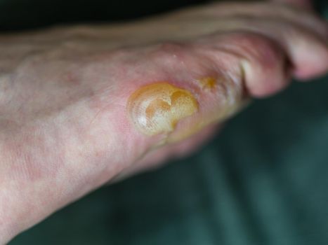Big blister on foot from Pompholyx eczema