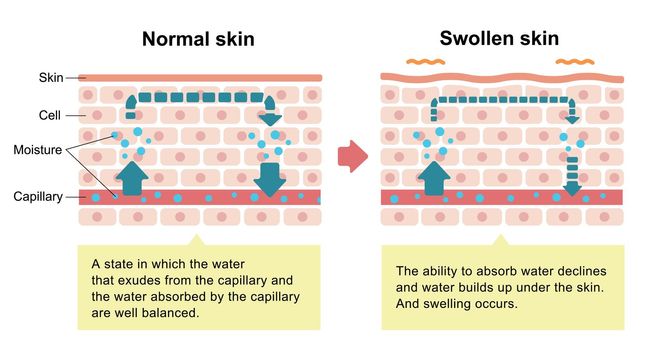 Comparison illustration of normal skin and swollen skin