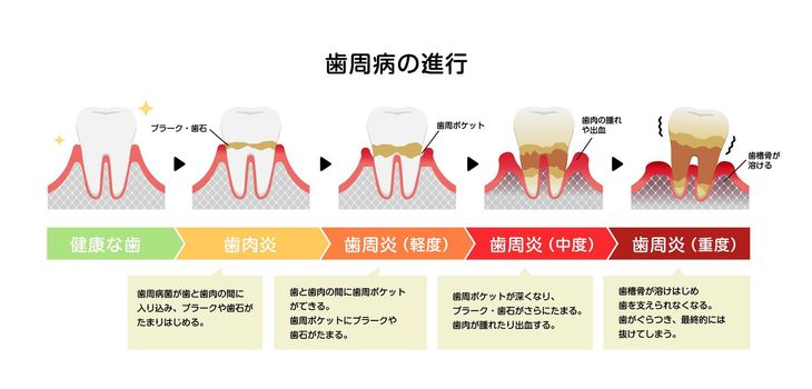 The stages of periodontitis disease vector illustration