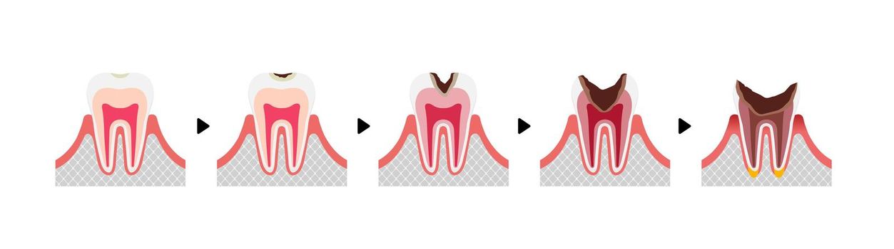 The stages of tooth decay / flat vector illustration (no text) 