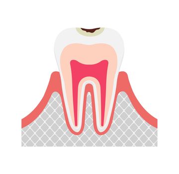 The stage of tooth decay / Decay in enamel
