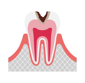 The stage of tooth decay / Decay in dentin