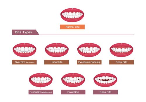 Teeth trouble ( bite type / crooked teeth ) vector illustration set