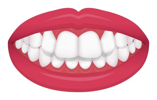 Teeth trouble ( bite type / crooked teeth ) vector illustration /Overbite (Back teeth)