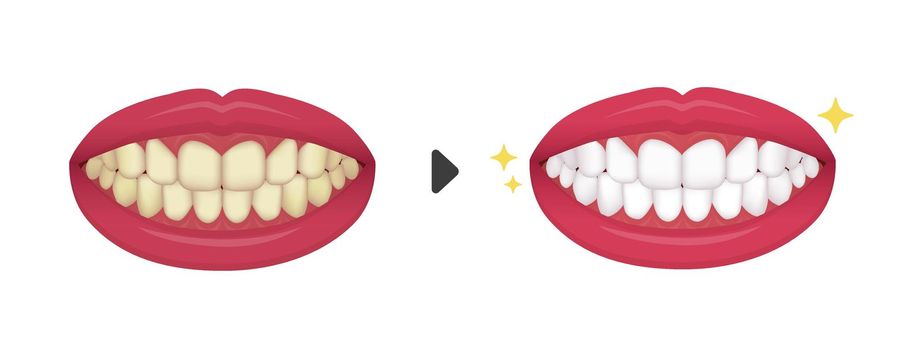 Teeth whitening vector illustration / before and after (No text)