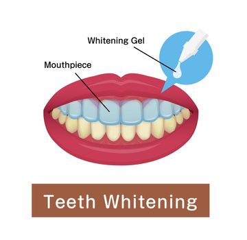 Teeth whitening at home vector illustration