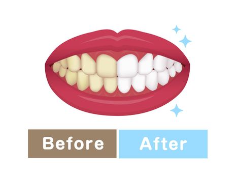 Teeth whitening vector illustration / before and after