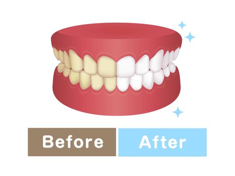 Teeth whitening vector illustration / before and after 
