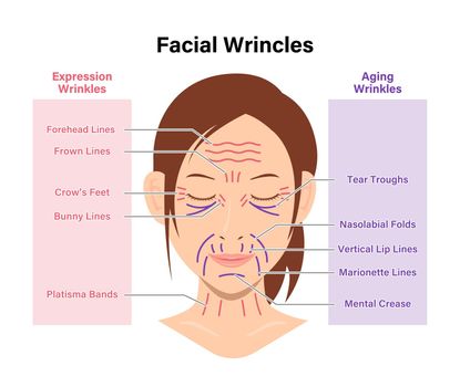 Expression wrinkles and Aging wrinkles ( female face ) vector illustration