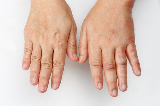 Shingles that causes a swollen hand