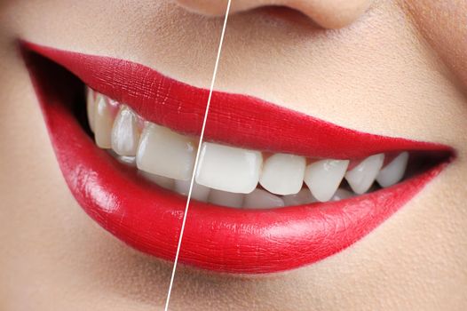 Before and after shot of red lipped woman teeth whitening