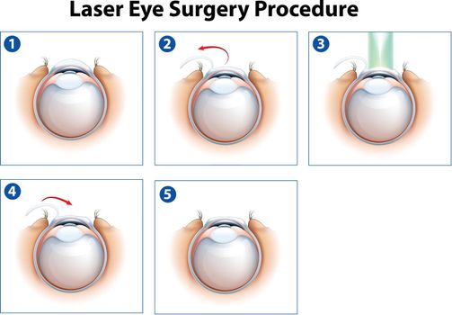 Laser Eye Surgery Procedure