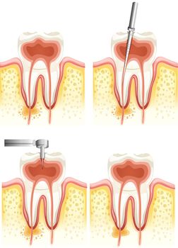 Dental root canal