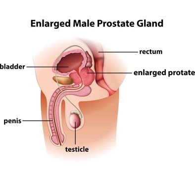Enlarged male prostate gland
