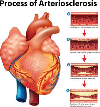 Process of Arteriosclerosis