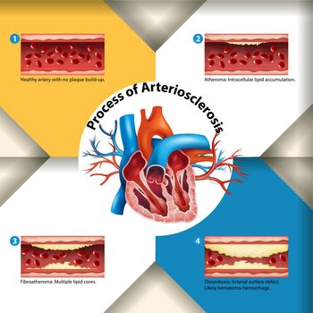 Process of Arteriosclerosis poster