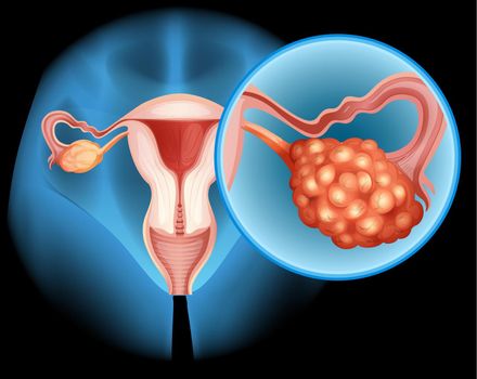 Ovarian cancer diagram in detail