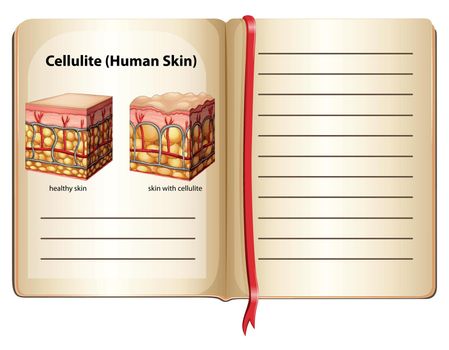 Cellulite under human skin