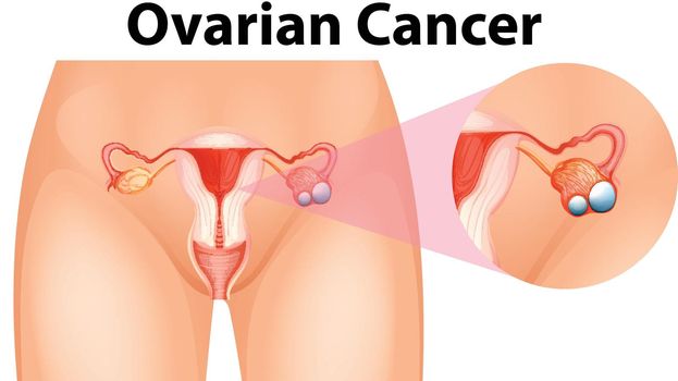 Diagram showing ovarian cancer