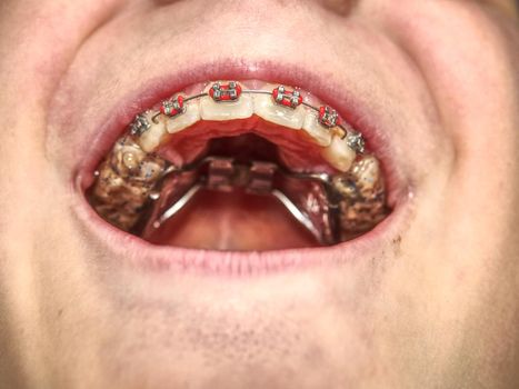 Especial high palatal braces for correction of birth defect. 
