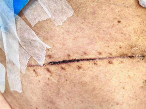 Bandage of fresh scar on the abdomen and side of the body.