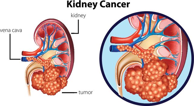 Diagram showing kidney cancer