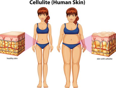 A Comparison of Women with Cellulite