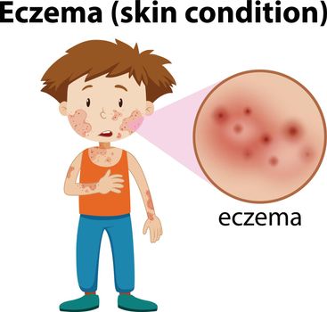 magnified eczema on young boy
