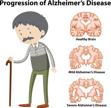 Progression of Alzheimer's disease