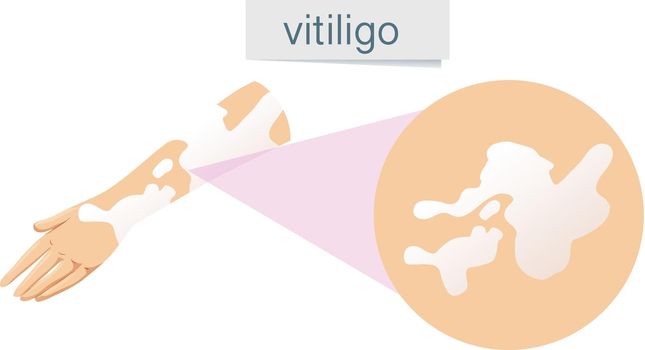 A Vector of Vitiligo on Skin