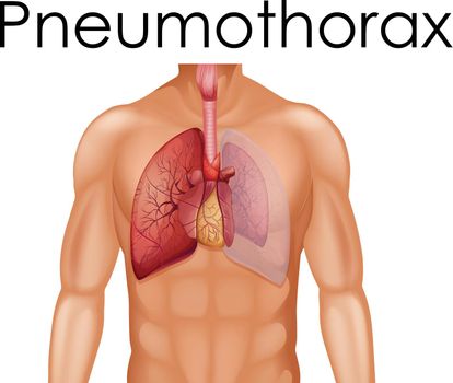 A Human Anatomy of Pneumothorax