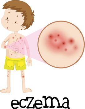 Human Medical Education of Eczema illustration