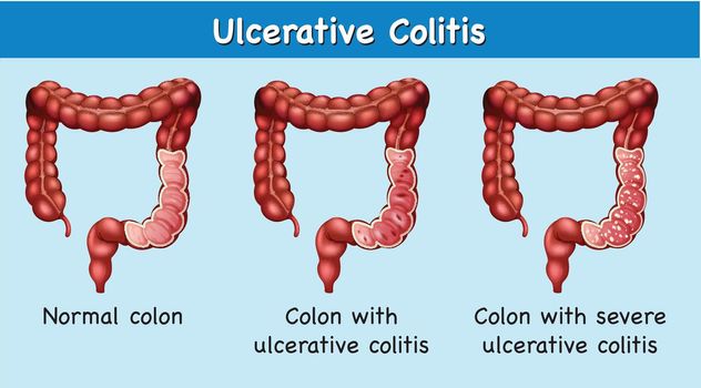 Diagram showing ulcerative colitis