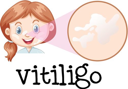 A Girl Face with Vitiligo