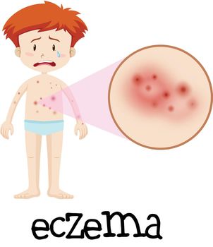 A Boy Having Eczema on Body Skin