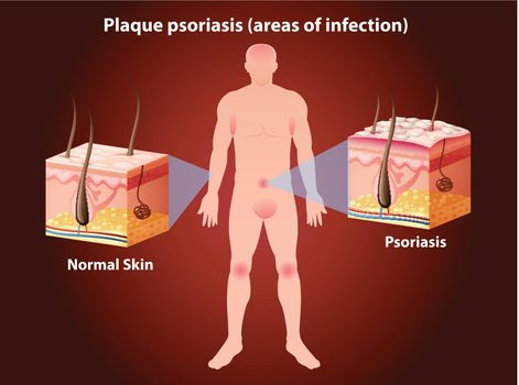 Diagram showing plaque psoriasis in human